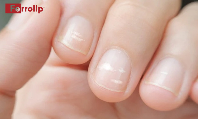 Vạch Beay trên móng tay khi thiếu chất