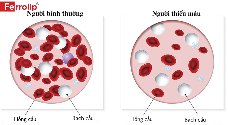 Sự khác nhau về số lượng hồng cầu của người bình thường và người thiếu máu