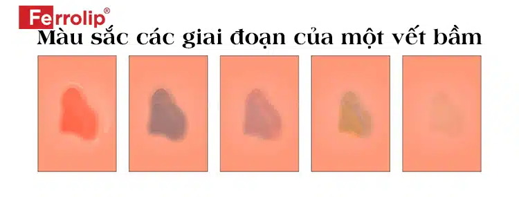 mau-sac-cac-giai-doan-cua-vet-bam