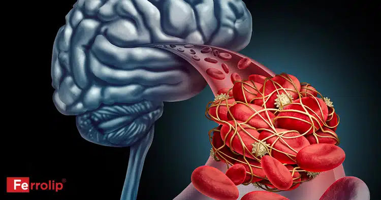 Cơn thiếu máu não thoáng qua có thể liên quan đến tắc nghẽn mạch máu não