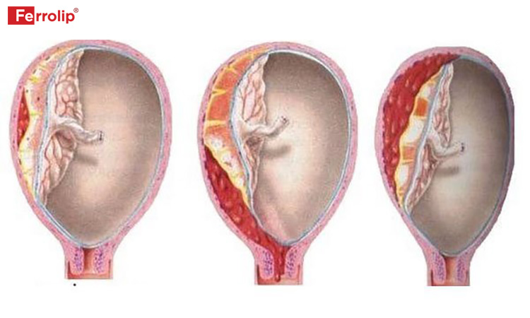 Hình ảnh túi thai bị bóc tách