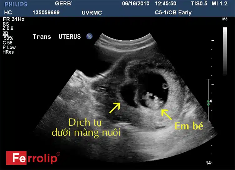 Hình ảnh siêu âm dịch tụ dưới màng nuôi