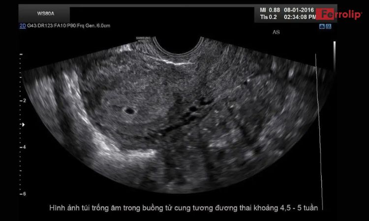 Hình ảnh siêu âm ổ bụng thai 4 tuần