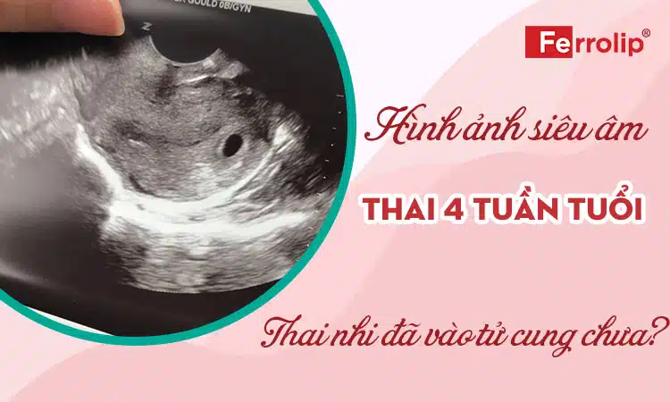 Hình ảnh siêu âm thai 4 tuần tuổi