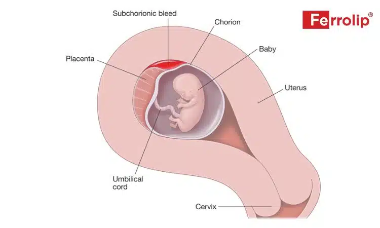 Tụ dịch màng nuôi bao nhiêu mm là nguy hiểm 