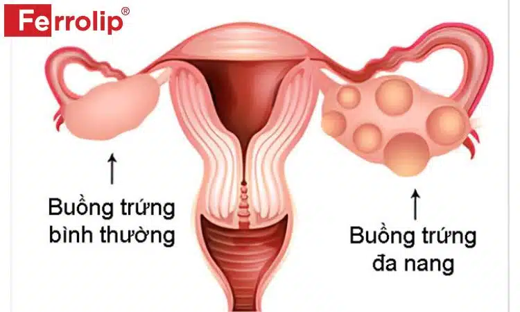 Bệnh lý trứng đa nang là một nguyên nhân khiến chu kì kinh nguyệt dài hơn