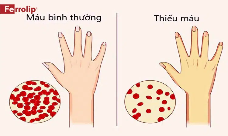 thiếu máu có gây vàng da không