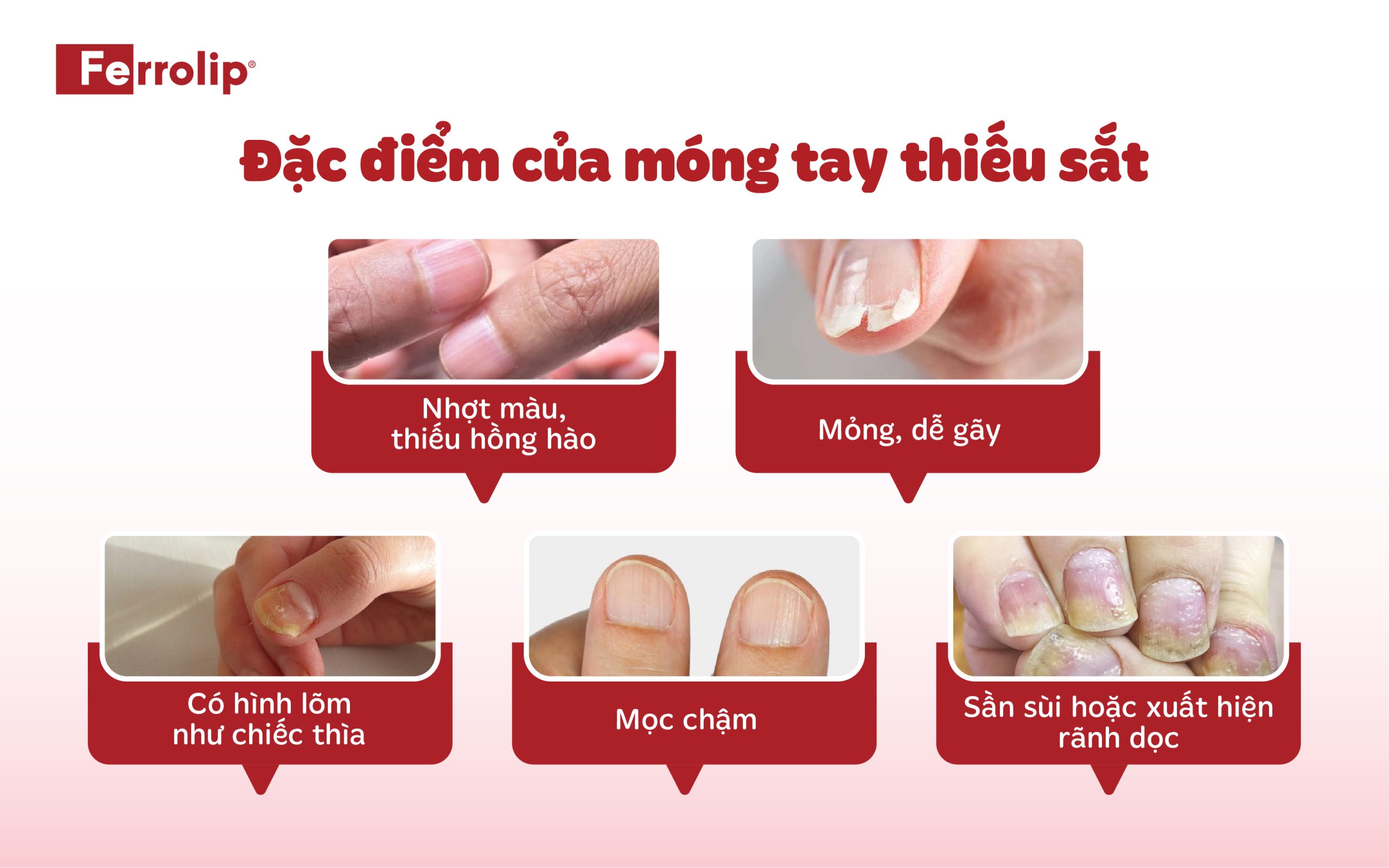đặc điểm của móng tay thiếu sắt