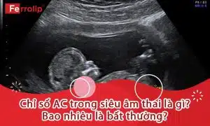 chỉ số ac trong siêu âm thai là gì