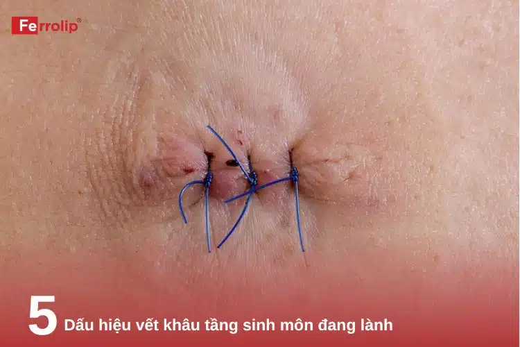 5 Dấu hiệu vết khâu tầng sinh môn đang lành