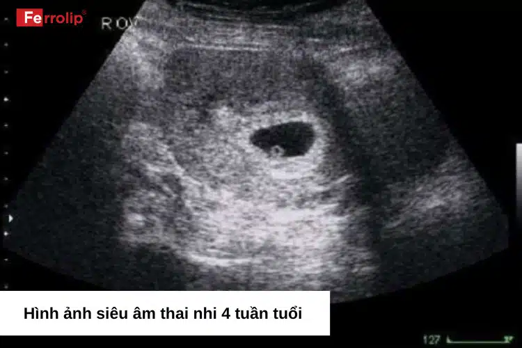 Thai 4 tuần siêu âm có thấy không?