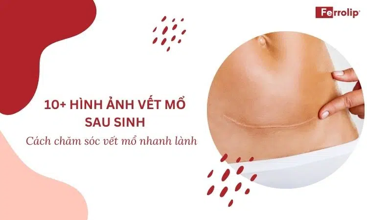 hình ảnh vết mổ sau sinh