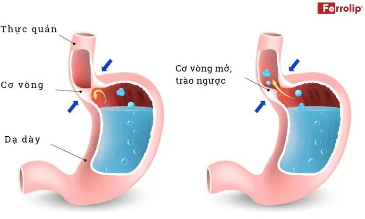 mẹ bầu bị trào ngược dạ dày