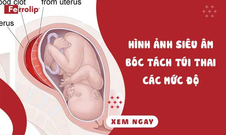 hình ảnh siêu âm bóc tách túi thai