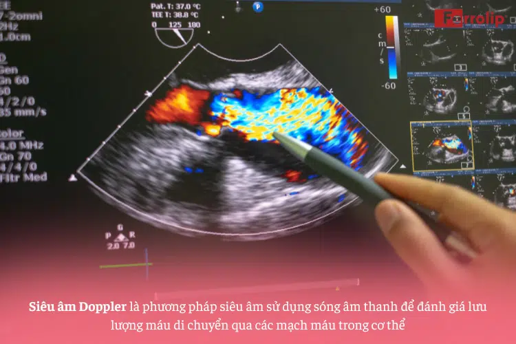 Chỉ số doppler đm rốn pi