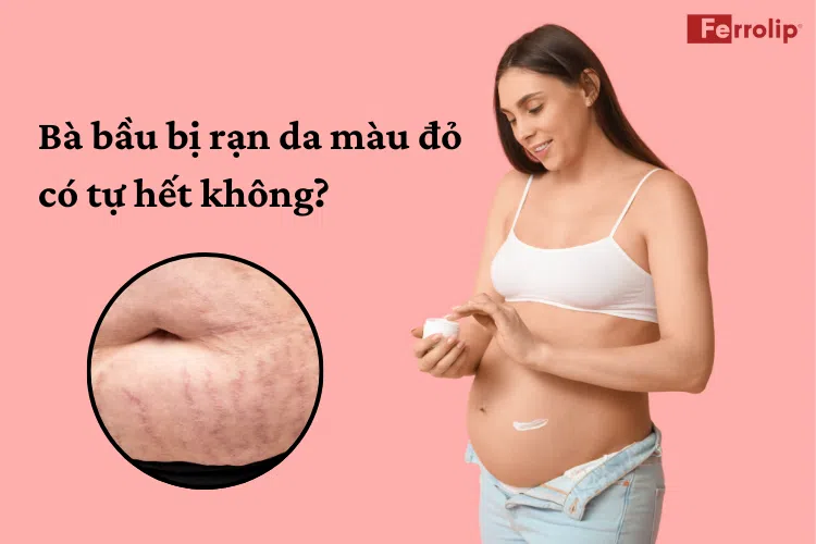 bà bầu bị rạn da màu đỏ có tự hết không