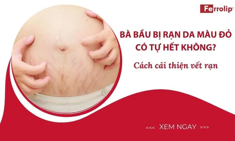 bà bầu bị rạn da màu đỏ