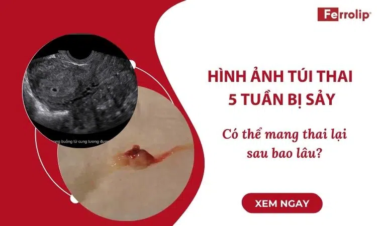 hình ảnh túi thai 5 tuần bị sảy