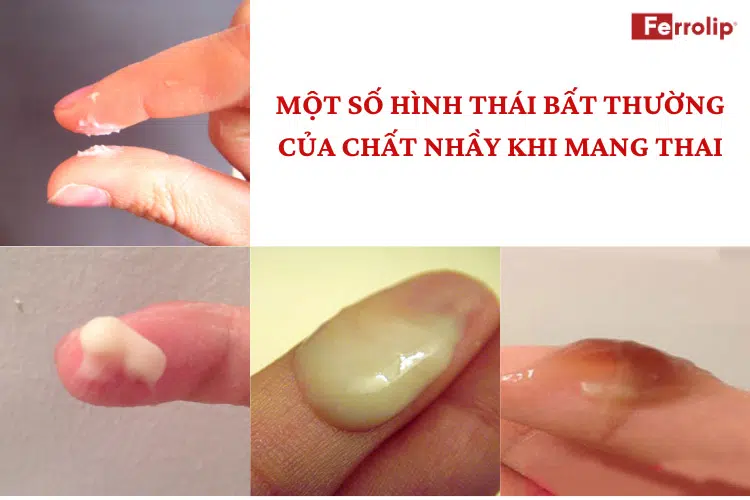 Hình ảnh chất nhầy khi mang thai bất thường