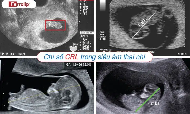 chỉ số CRL trong siêu âm thai nhi