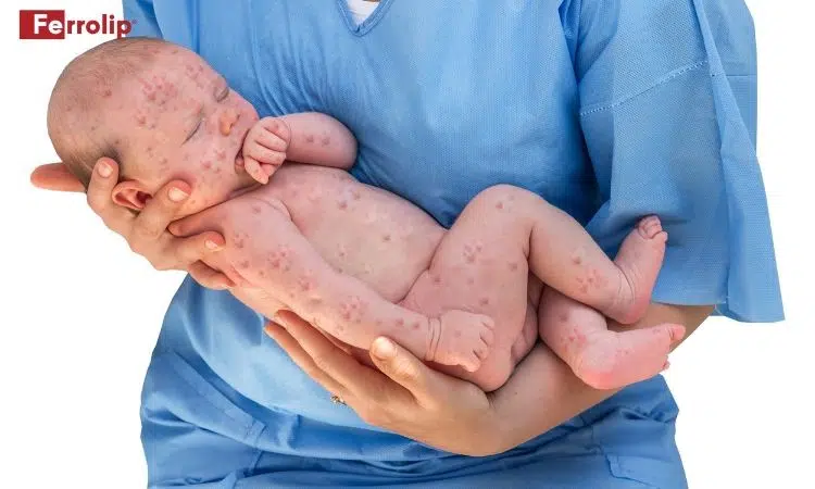 bị rubella khi mang thai