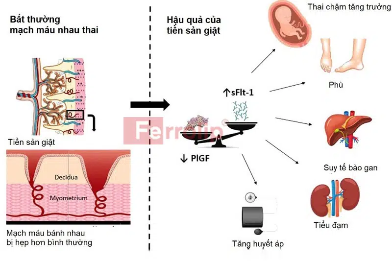 xét nghiệm tiền sản giật khi nào