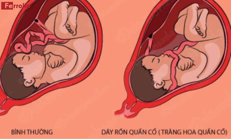 dây rốn quấn cổ 1 vòng có sao không