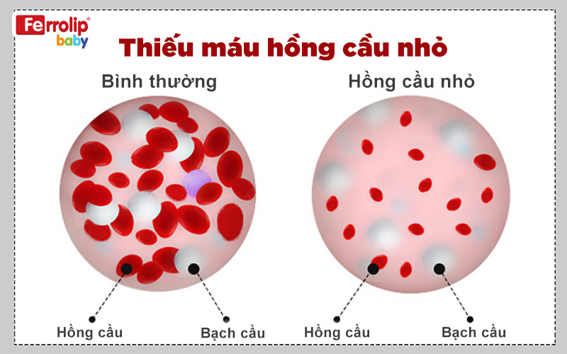 Thiếu máu hồng cầu nhỏ ở trẻ em là tình trạng hồng cầu có kích thước nhỏ hơn bình thường