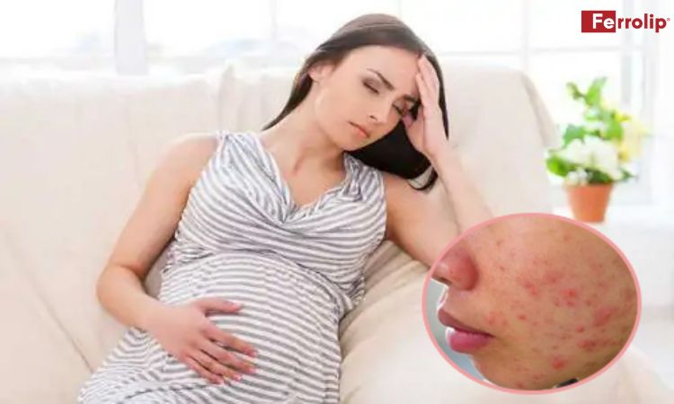 nổi mụn khi mang thai
