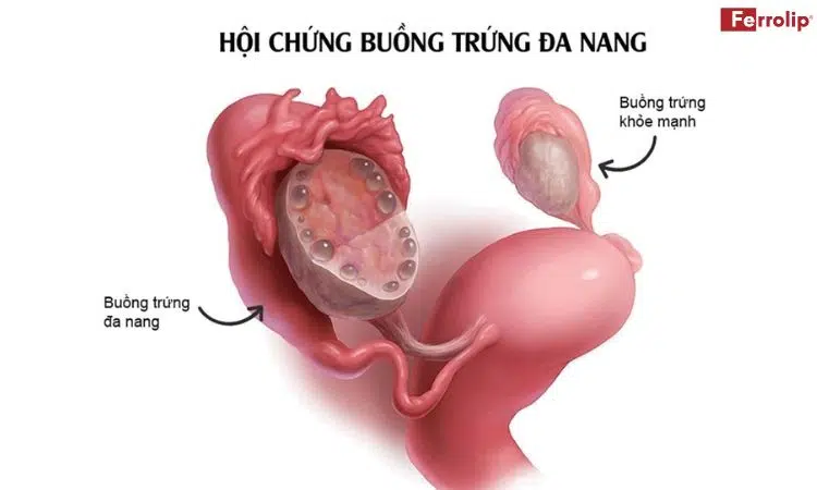 AMH cao khả năng là đa nang buồng trứng