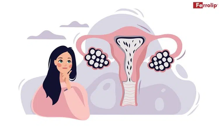 buồng trứng đa nang có nguy hiểm không