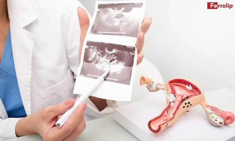 mắc buồng trứng đa nang có sao không