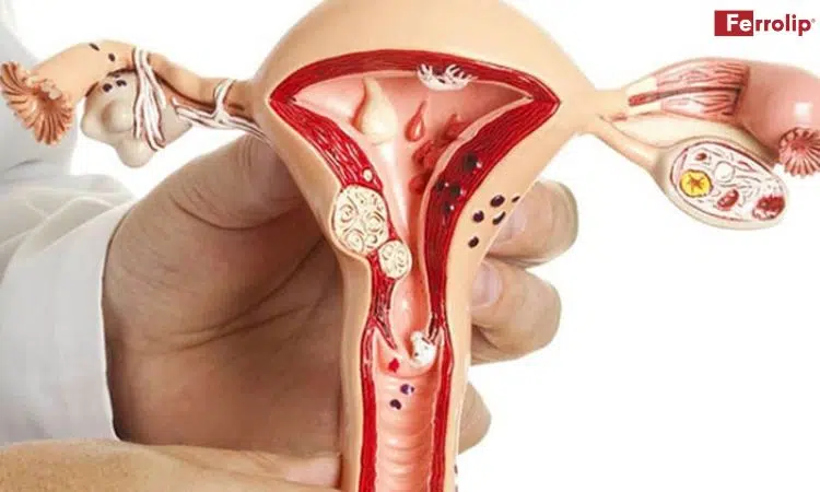 polyp tử cung có mang thai được không