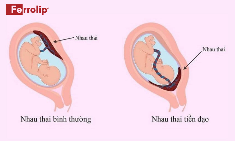 tư thế nằm khi bị nhau tiền đạo