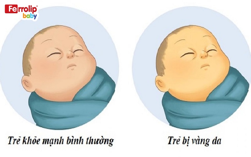 Nếu trẻ ăn gan quá nhiều, có thể dẫn đến vàng da do thừa vitamin A