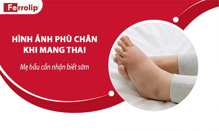 hình ảnh phù chân khi mang thai