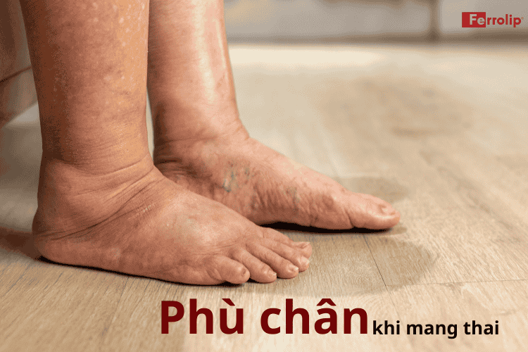 Hình ảnh phù chân khi mang thai