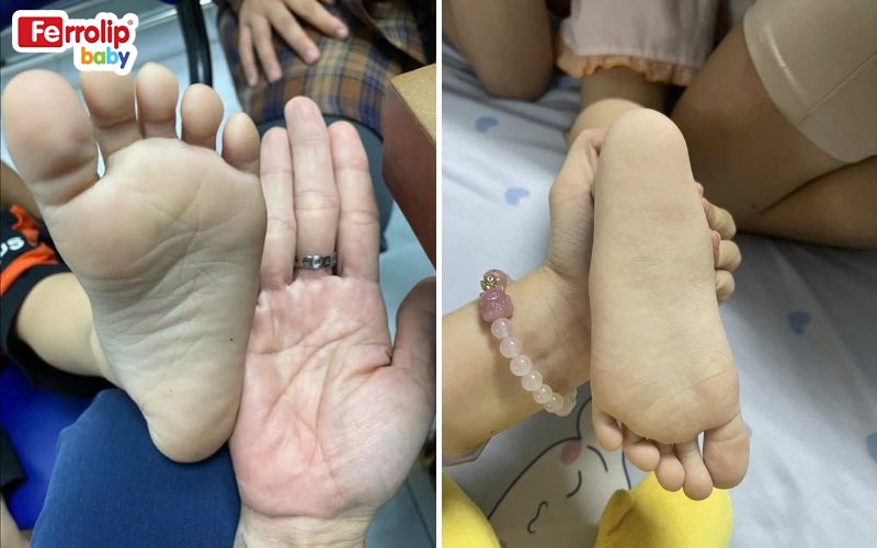 Lòng bàn chân trắng bệch