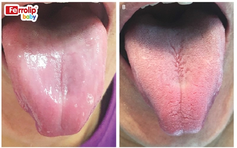 Lưỡi mất gai