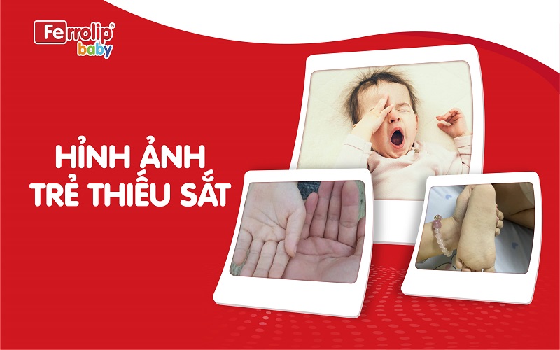 Hình ảnh trẻ thiếu sắt
