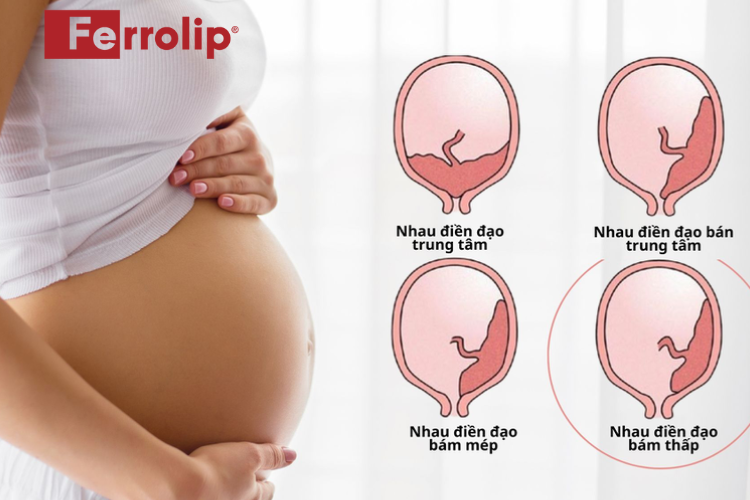 Hình ảnh nhau thai bám thấp