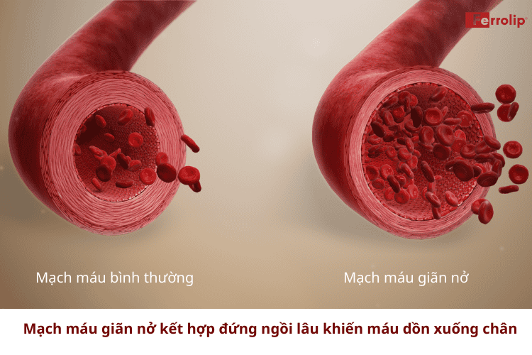 Mạch máu giãn nở kết hợp đứng ngồi lâu khiến chân bị phù