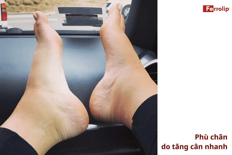 Tăng cân nhanh có thể khiến chân bị phù