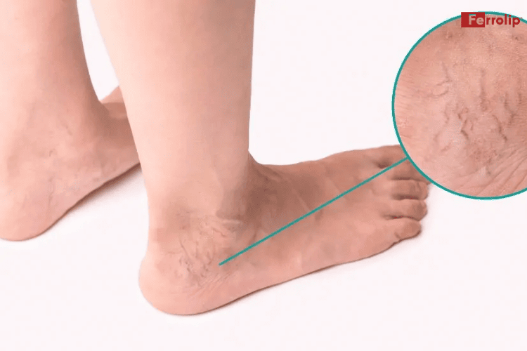 Phù chân kèm nổi gân xanh hoặc bầm tím chân