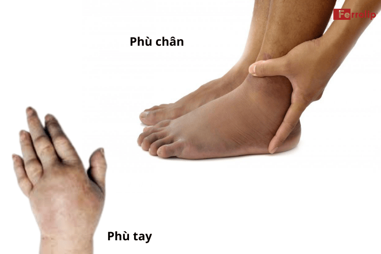 Phù chân kèm phù tay