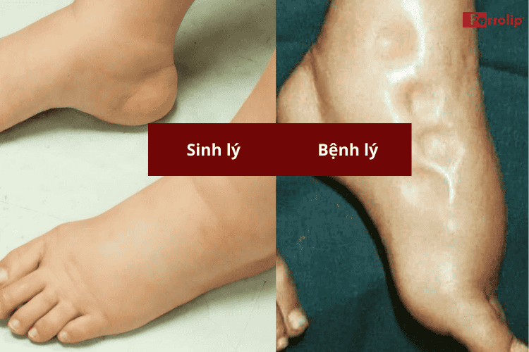Hình ảnh phù chân sinh lý và phù chân bệnh lý