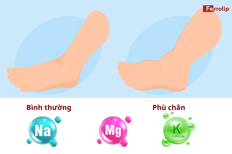 Thiếu kali và magie cũng có thể gây phù chân