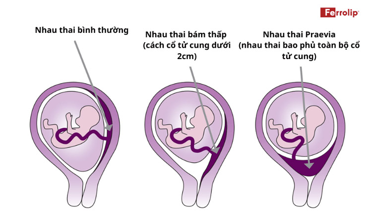 Các trường hợp nhau thai bám thấp