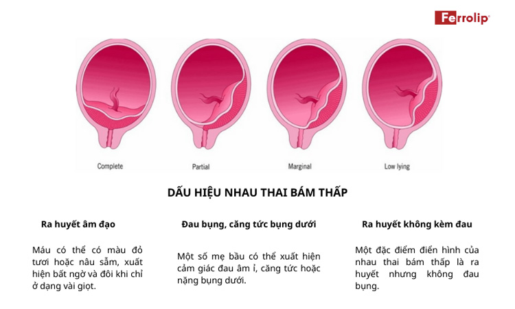 Dấu hiệu nhau thai bám thấp