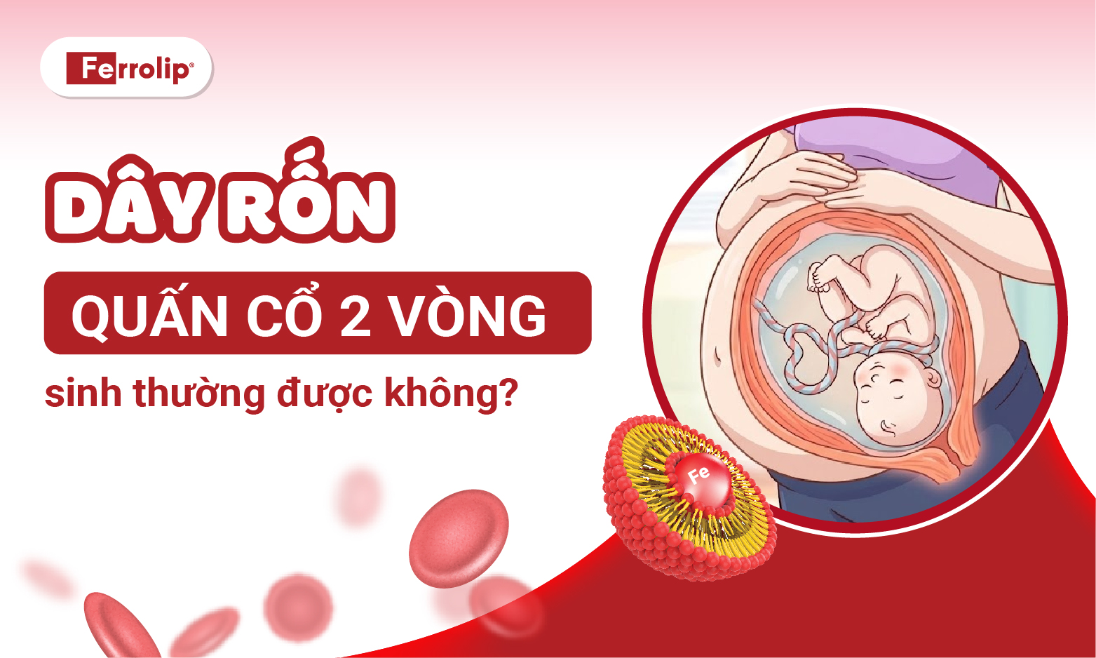 Ảnh tiêu đề dây rốn quấn cố 2 vòng